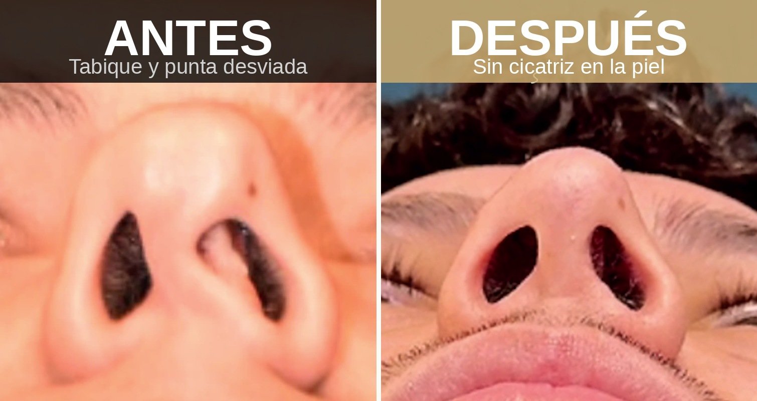 Antes y después de rinoplastia cerrada · Tabique y punta desviada · Sin cicatriz en la piel