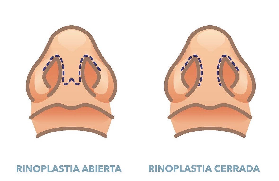 Comparación rinoplastia abierta vs cerrada - incisiones