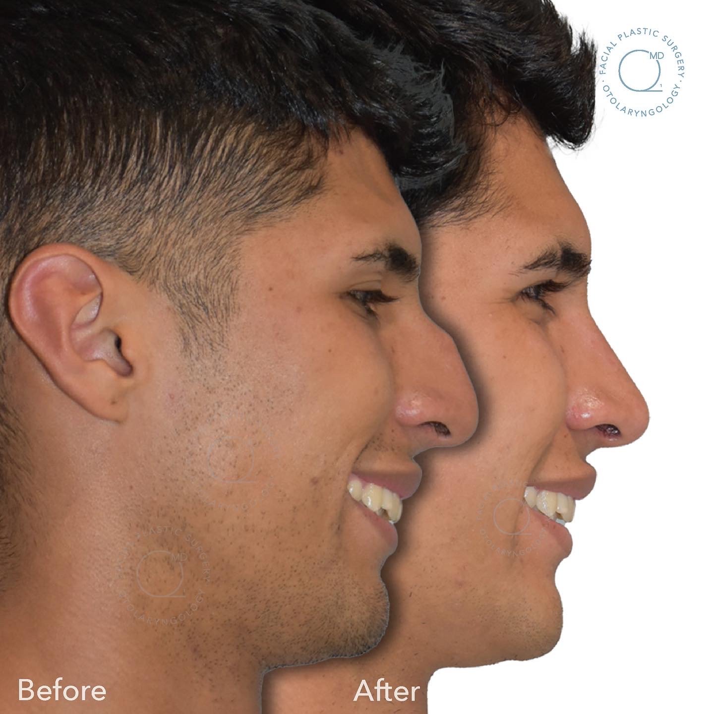 Antes y después rinoplastia masculina cerrada Dr. Jorge Duque Madrid