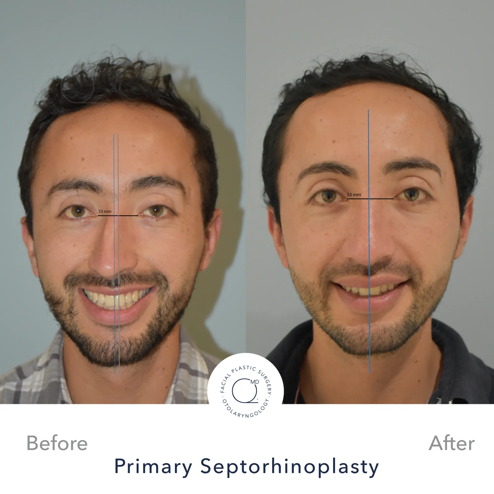 Antes y después septorrinoplastia masculina Dr. Jorge Duque Madrid
